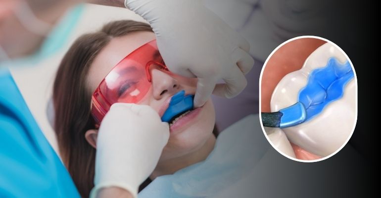 Fluoride & Dental Sealants Treatment In Nadiad