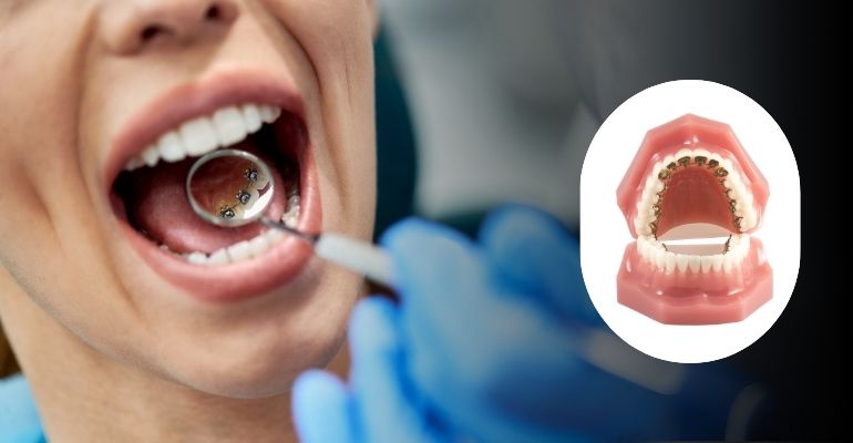 Lingual Braces Treatment In Nadiad