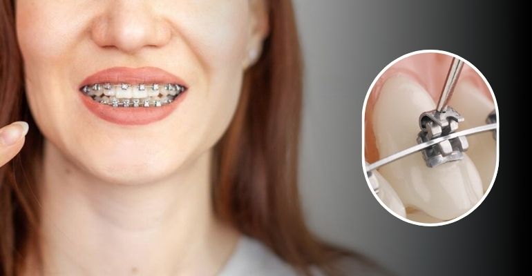 Self-ligating Braces Treatment In Nadiad