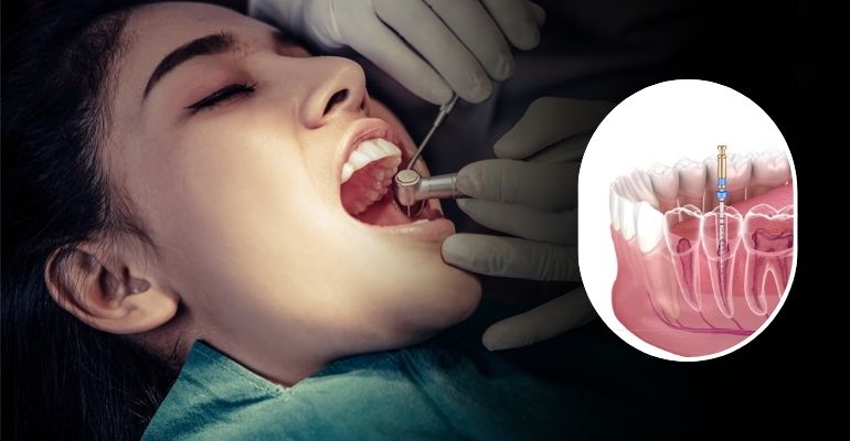 Single Sitting Root Canal Treatment in Nadiad