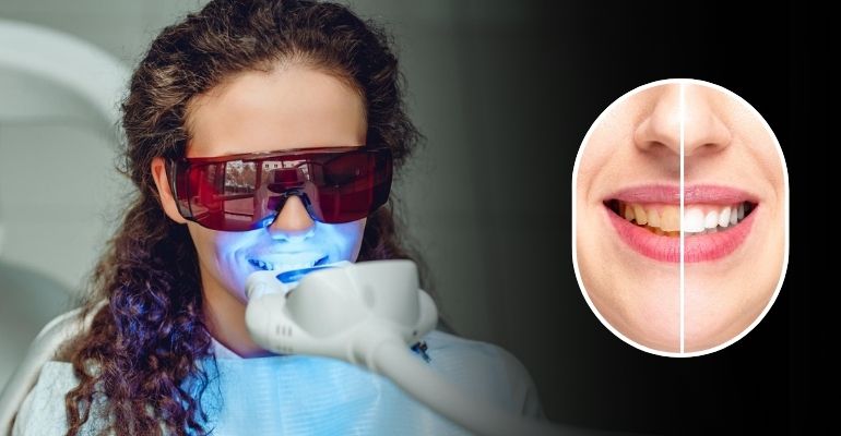 Teeth Whitening in Nadiad