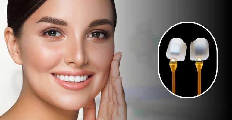 Veneers in Nadiad